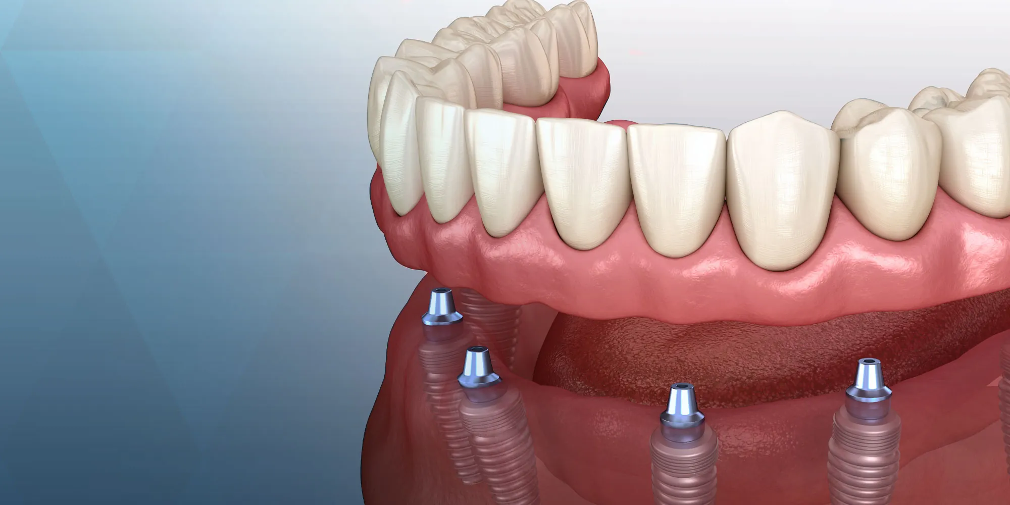 Dental Implants